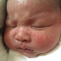 宝妈们有知道这是什么的吗，我婆婆说这是胎毒不用理，不知道是什么