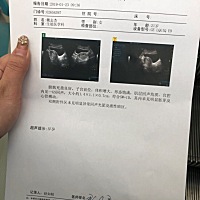 今天刚到医院做了个B超，回家吃药保胎