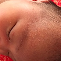 俺家闺女脸上这几天出现这样小疙瘩，没满月。咋回事？