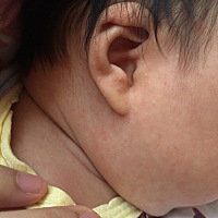 请教脸脖子那的红点点是热出来的吗？？