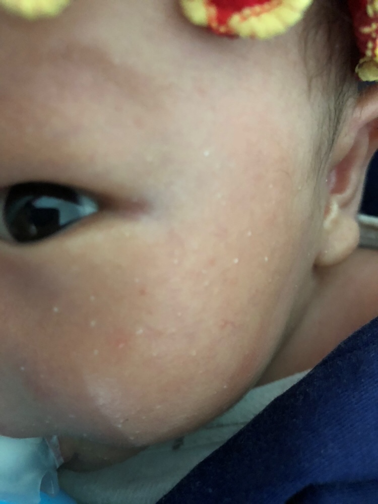 谁知道刚出生的婴儿脸上出的这白点点是什么东西吗？？