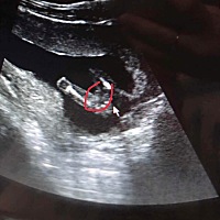 孕15周加3天今天查了男孩女孩，私人的，告诉我说是女孩，这个准确吗？图片那个又是什么？纠结，其实女孩...