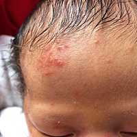 有没有宝妈知道宝宝脸上还有额头上长的这是什么？急！