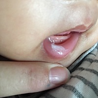 亲们，这个是鹅口疮吗？擦不掉的，有没有哪位宝妈知道