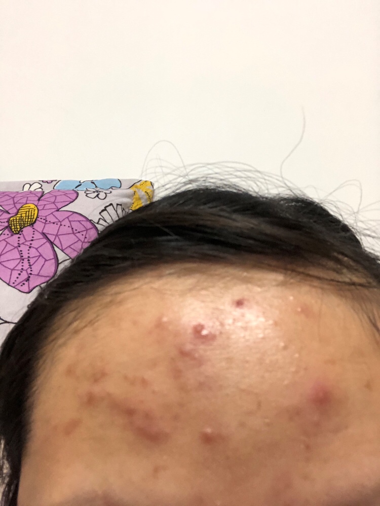 全是痘痘啊