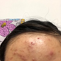 各位宝妈。有没有生完孩子脸上疯狂长痘痘的？这是怎么回事啊？有没有可以消除痘痘的方法啊 全是痘痘啊