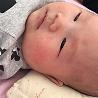 宝宝脸上湿疹有点厉害抹点什么好的快呢？