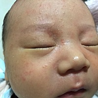 宝宝出生15天开始长的，开始只有脸颊的几个，去了医院两次，医生说正常，孩子大了就没了，也没说长得是...