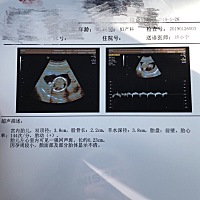 有没有遇到过这种情况的孕妈？ 胎儿左心室强回声斑 医生说会吸收？