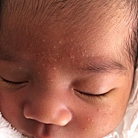 宝宝十一天，脸上小白点是什么？