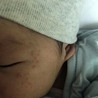 问下大家宝宝脸上这个小颗粒是不是热的湿疹？就这两天长的