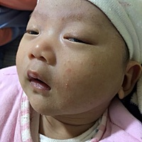 崽崽脸上长好多湿疹，心疼