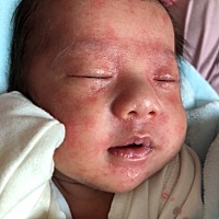 这是湿疹吗，可咋办呀？