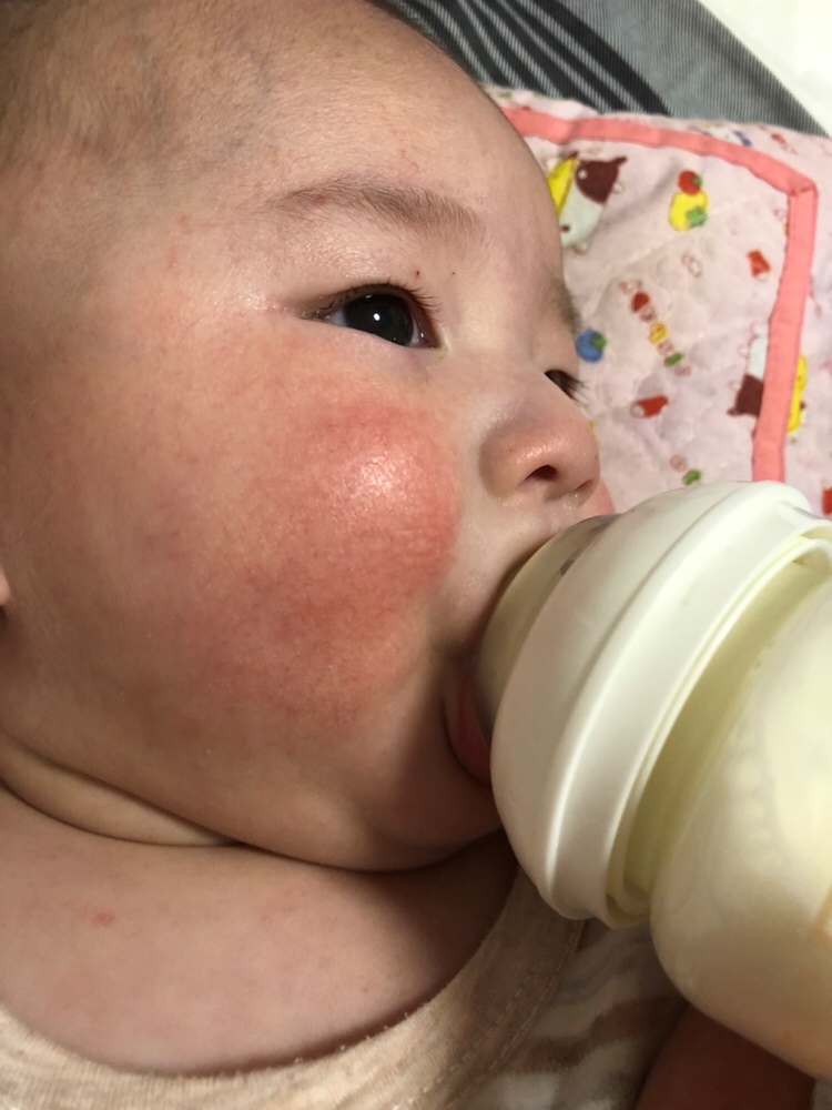 这个是怎么回事五个月了 医生说一岁左右好 求推介
红血丝