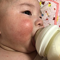 这个是怎么回事五个月了 医生说一岁左右好 求推介 红血丝