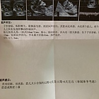 今天去做NT，单绒单羊双胞胎，医生说很危险，有没有和我一样的，这怎么办啊？