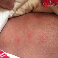 宝宝17天，今天洗澡发现肚皮胸前有红色小斑块如图，有宝妈知道是什么原因吗？？？