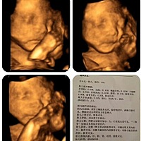 四维和心脏超声检查请提前一个月预约，拿到宝宝照片会好惊喜哦