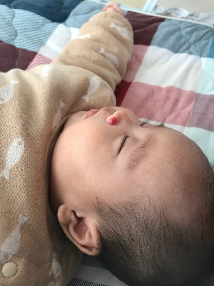 有人知道宝宝鼻子上的是什么？？