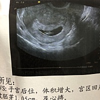 孕囊是长长的，就是男孩子吗