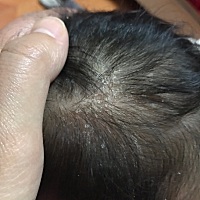 求助，各位宝妈们帮忙看看 我家宝宝头上突然出现了这类似头皮屑的东西，洗也洗不掉，干了还是有，从出生...
