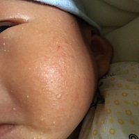 小脸不知道是不是晒太阳的时候风吹的。还是喝奶粉的原因。像锅巴一样。硬硬的，涂了红霉素软膏也不行。...