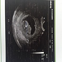 孕10周 宝宝的第一张照片 还看不出来样子 哈哈😄