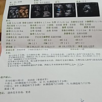 今天做了后期的四维，之前医生有说双胎容易早产，可是这次问什么时候进医院生产也没说，因为家里离医院...