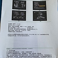 老大三岁了，破腹产隔了三年怀上二胎一直都很轻松、可是五个多月做个彩超居然胎盘植入，一直觉得二胎轻...