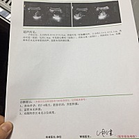 纠结。有跟我同样情况的吗。吃了紧急怀孕了。 宫腔有积液。说有先兆流产迹象。