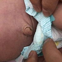 女宝宝今天16天，脐带自然脱落，但是肚脐突出，有没有宝妈遇到过类似的情况