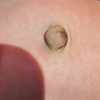 宝宝四十一天了   今天换尿不湿的时候突然发现肚脐眼突出了    各位宝妈有相同情况的吗