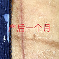 我剖腹产两个月了 这两天发现伤口有刺痛感 颜色比之前红了 感觉有点突出 图一是剖腹产一个月的伤口 ...