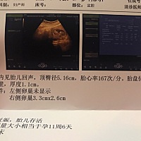 求宝妈  解惑 宝宝胎心率167/分 是不是跳太快了 B超检测  右侧卵巢3.3×2.6cm需要做手术嘛？   孕12周
