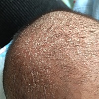 宝宝两个月 天天洗头发 怎么就是洗不掉。宝宝都有吗