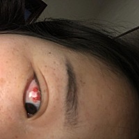 怀孕30周，一觉醒来眼睛就这样了