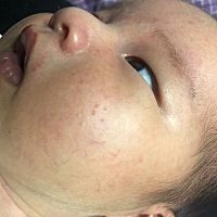 请问这是什么 脸上的疙瘩
