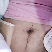 十二天了，刀口才恢复成这样自己都不怎么敢看，看到都疼！