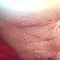 有月子里的宝妈手心脱皮，还特别的痒么，怎么办