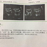 请各位有经验的孕妈们帮我看一下，医生说胎儿偏右侧宫角，该怎么办？正常吗？医生让我过十天再去检查 p