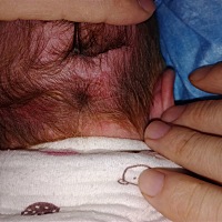 各位宝妈们，宝宝一个多月，后脑勺有红色的小片片，怎样才能退下去呢?