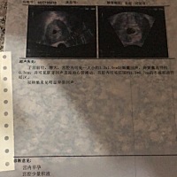 亲们 宫内早孕 宫腔少量积液慧早产吗？有这样的宝妈吗？好担心😭😭