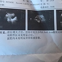 怀孕初期出血！去医院做了B超，排除宫外孕，保胎希望能保住🙏🙏🙏🙏