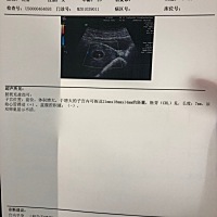 我是2018年11月30号来的最后一次例假，到今天应该有两个月了，但今天去做的彩超，说才有6周4天，这是什...