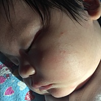 两边脸上都长这种疙瘩 一使劲就变红了 是湿疹么  用不用去医院看看？