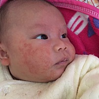 湿疹严重 看着都心疼 搽了茶油