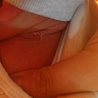 十几天的宝宝脱皮，擦什么啊！脖子经常吐奶，都弄湿了，每次给他用水擦脖子，都不敢太大力，就怕弄疼他...