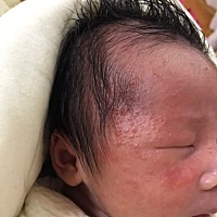 宝宝得了好严重的湿疹怎么办呀？有没有谁有好的方法能好得快的？