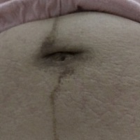 肚子上的妊娠线和淡淡的妊娠纹什么时候可以恢复？肚皮松弛怎么办？