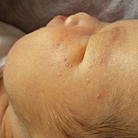 有没有宝妈知道这是什么痘痘，需要擦掉什么药膏么？谢谢了！